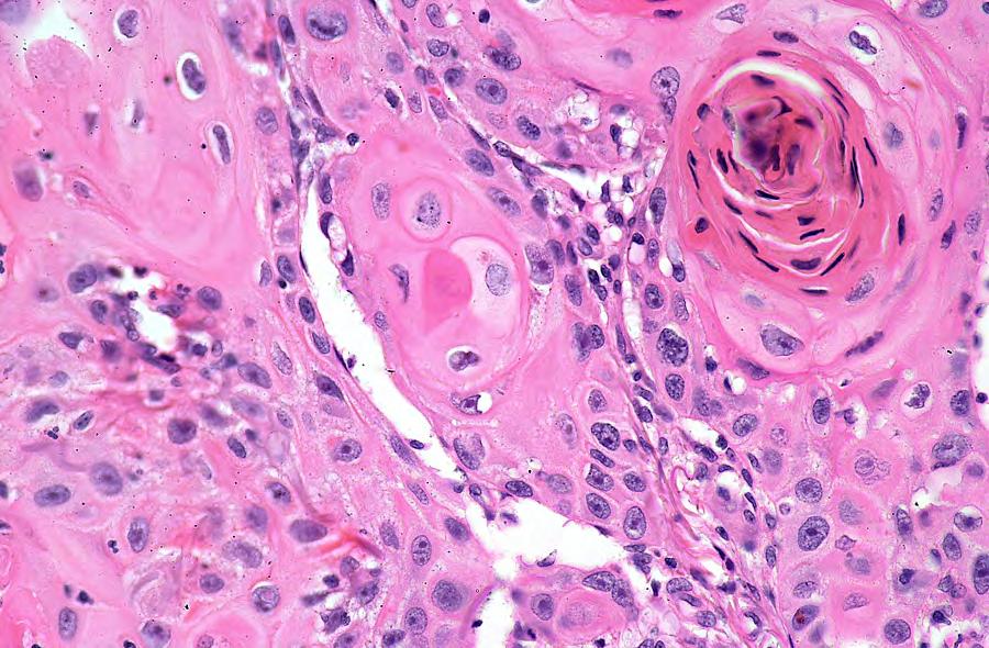 Squamous cell carcinoma. High power view of tumour cells (tumour cells only, the invasive nature of the cells cannot be seen here).