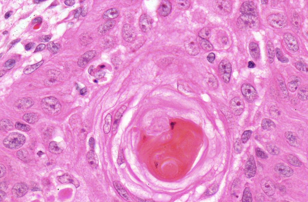 Squamous cell carcinoma. High power view of tumour cells. The cells show cytological features of malignancy: nuclear enlargement, pleomorphism, prominent nucleoli.