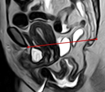Nada Hussein et al. Table (6): Agreement between Physical Examination and MRI Findings Regarding Posterior Compartment in Included Patients. Physical examination MRI findings Normal Rectocele No.