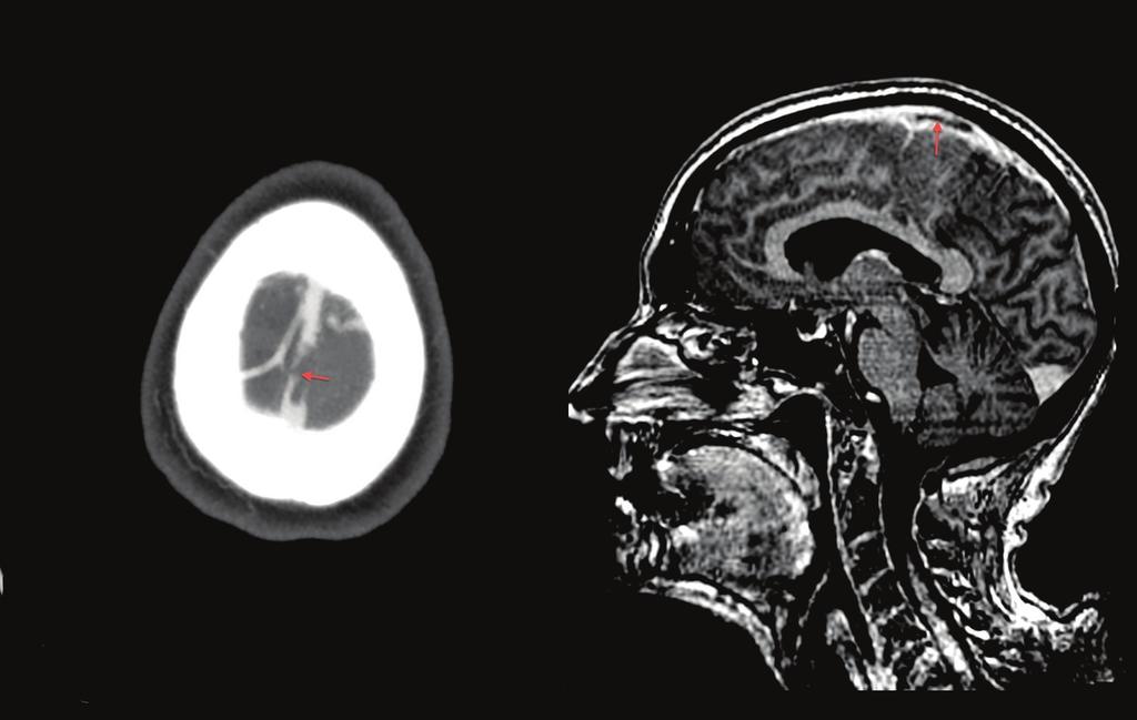 2 Case Reports in Medicine Figure 1: Brain computed tomography showing superior sagittal sinus thrombosis and implication of a cortical vein (arrows).