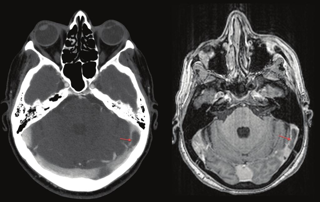 Figure 3: T2-weighted FLAIR magnetic resonance showing massive left frontotemporal hemorrhagic infarction. cases of intracranial venous thrombosis.
