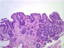 edu Case 1 The following biopsies are taken from the distal esophagus of a 57 year old man who has a history of