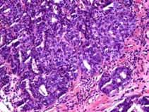 Solid/cribriform pattern Riddell OESO, 1998 The only criterion for the confident diagnosis of invasive carcinoma in the lamina propria is the pathologist s own subjective and personal interpretation