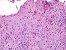 increased lymphocytes and mast cells Huge numbers of eosinophils, eosinophil