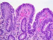 usually not full thickness of epithelium Polarity retained These features involve the surface, not just the