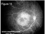 Retcam fundus picture Fluorescein angiography