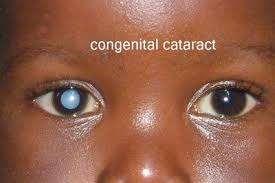 disease Practical points in ROP The most common Cataract