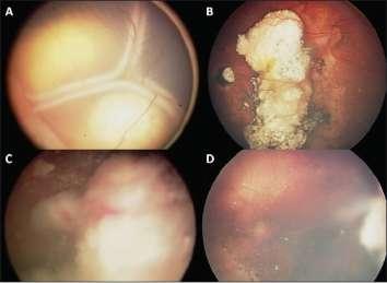 Advanced Group E retinoblastoma (A) treated with systemic chemotherapy showing compete tumor regression