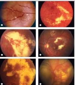 Differential Diagnosis In an oncology referral practice, 48% of lesions referred to as retinoblastoma proved to be pseudoretinoblastoma.