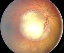 Retinoblastoma The commonest primary intra ocular malignancy in childhood originating from primitive retinoblasts with tendency towards cone differentiation (from the inner neuroepithelial layers of