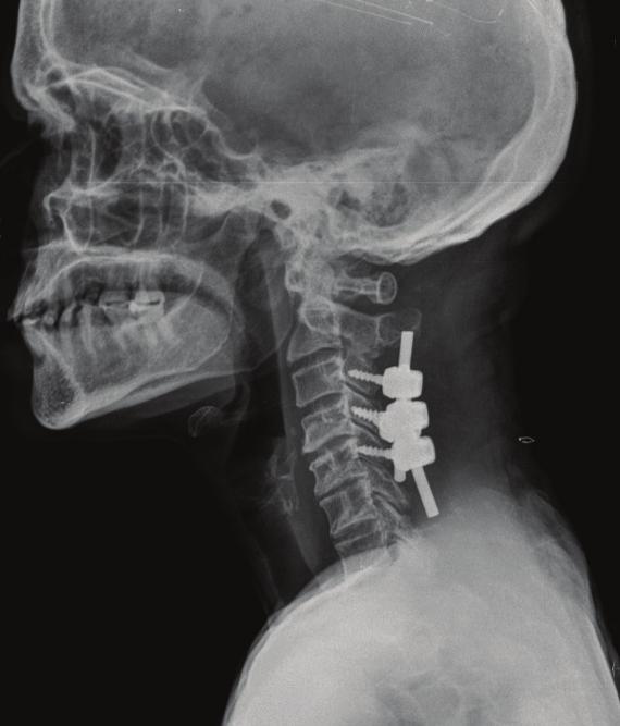 C3, C4, C5 Figure 2: b) Showing lateral mass screws fixation
