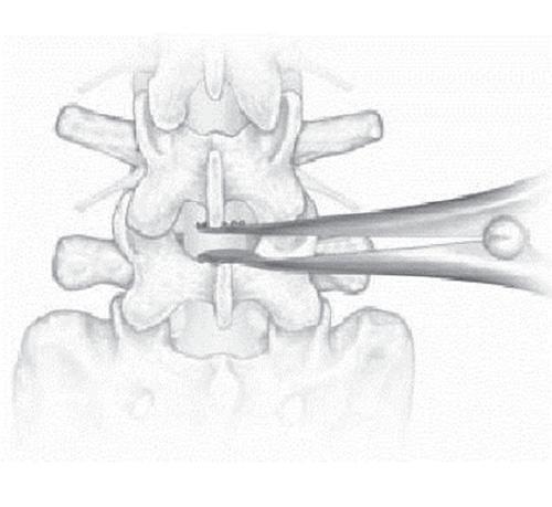They may be used for temporary disc distraction during implant insertion If a facet screw system is used, lateral exposure only to the facets may be used Percutaneous facet screws may be placed on