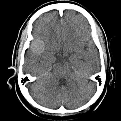 SPONTNEOUS COMPLETE OCCLUSION OF MC NEURYSM C C Fig. 1. () xial computed tomography (CT) scan shows a slightly high-density intra axial mass lesion measuring approximately 2.