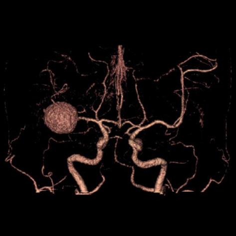 () T2 weighted images from a brain magnetic resonance image (MRI) examination show a high signal in the aneurysm sac and a heterogeneous, peripheral low signal.