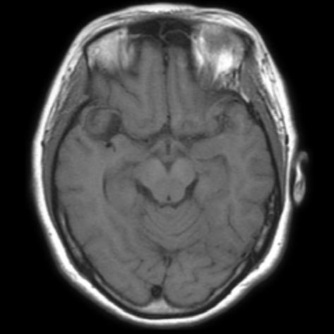 Findings on brain computed tomography (CT) examination showed a slightly high-density intra axial mass lesion measuring approximately 2.