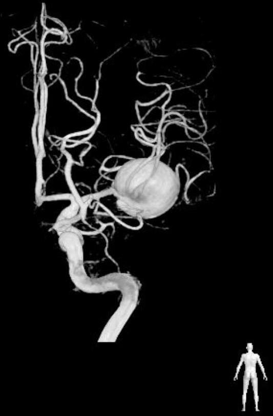 t the back of the aneurysm sac, M2 branches were advanced and deviated toward the medial side.