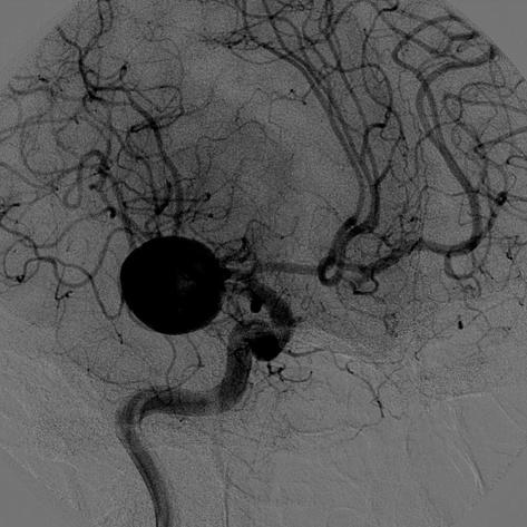 aneurysm. () fter 19 months, the size of the aneurysm shows a considerable decrease. C Fig. 4. Right internal carotid artery angiogram.