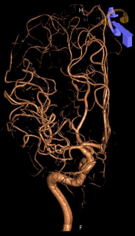 n examination Direct clipping in the operation field was difficult; after 19 months showed that the size of the aneurysm therefore, the operation was completed after wrap-