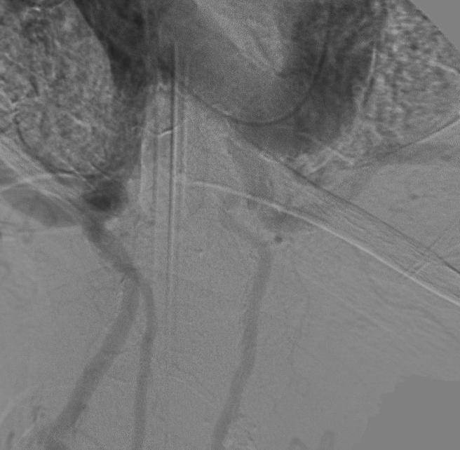 Figure 3: Digital subtraction angiography, Left anterior oblique projection of the aortic arch, demonstrating a complete occlusion of left common