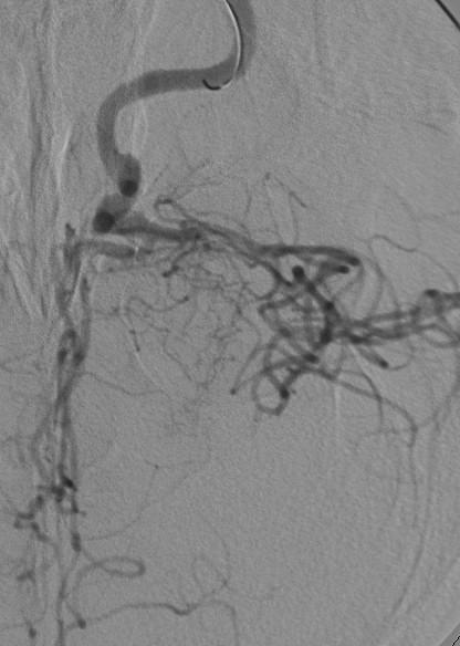 L ACA ACA MCA MCA LCCA Figure 5a Figure 5b Figure 6 Figure 5a: Catheter angiogram, lateral view of the left common carotid artery.