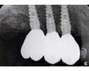 Notice that on the molar in the right lower jaw there is presence of a