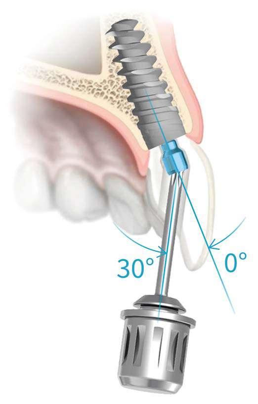 JD screw angulated channel technology: For screw retained rehabilitations with greater aesthetic, simplicity and ease of management over time: Useful to correct the inclination of the access hole