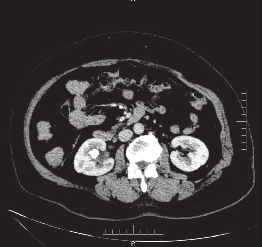 MRI also showed a hypointense peripelvic lesion inside the kidney, causing right renal pelvic compression.