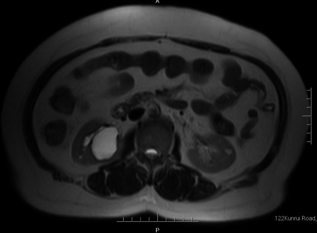 Following all these investigation, the diagnosis of this mass was a peripelvic renal cyst completely inside the kidney compressing renal pelvis and causing hydronephrosis.