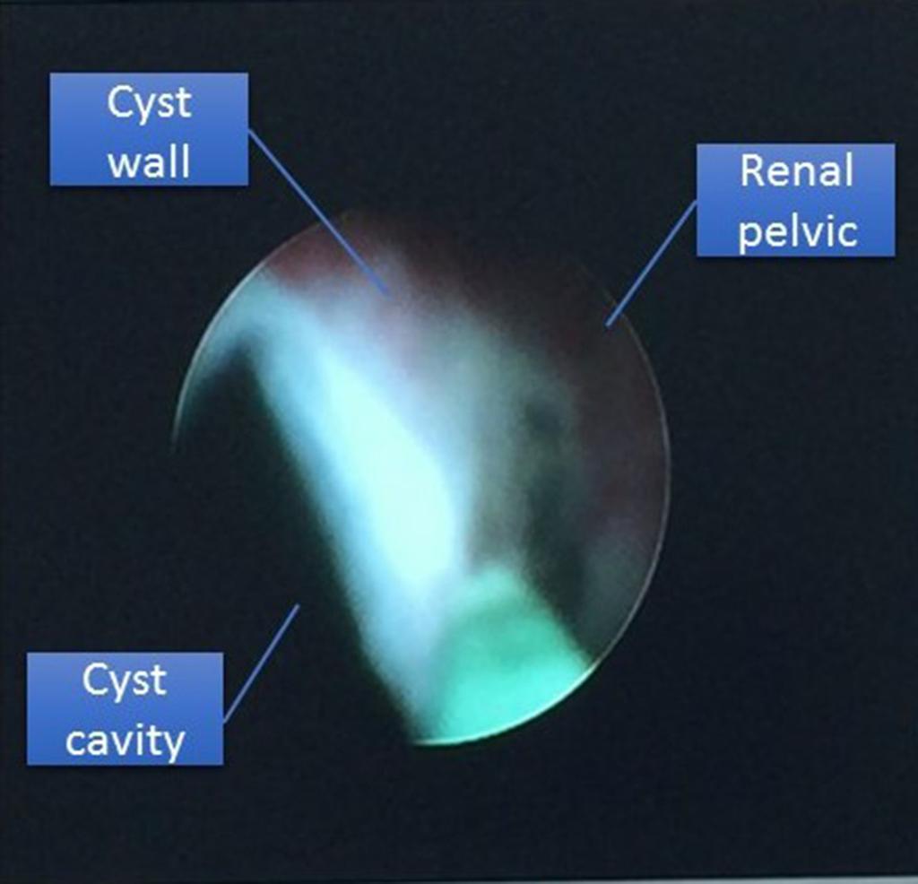 B. Yang et al. Treatment of peripelvic renal cyst by percutaneous nephroscopy punctured, avoiding the cyst to get punctured.