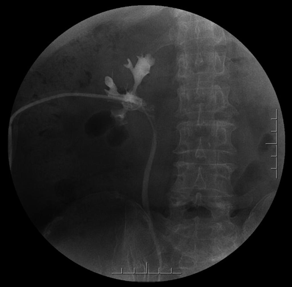 Treatment of peripelvic renal cyst by percutaneous nephroscopy B. Yang et al. cyst cavity was not noticed and the shape of the calyx had become normal.