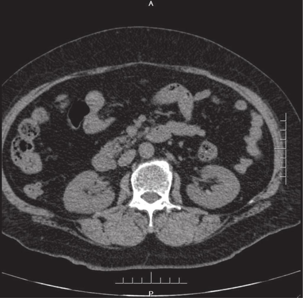One month after the operation, the nephrostomy tube was removed and CT scan was performed (Fig.