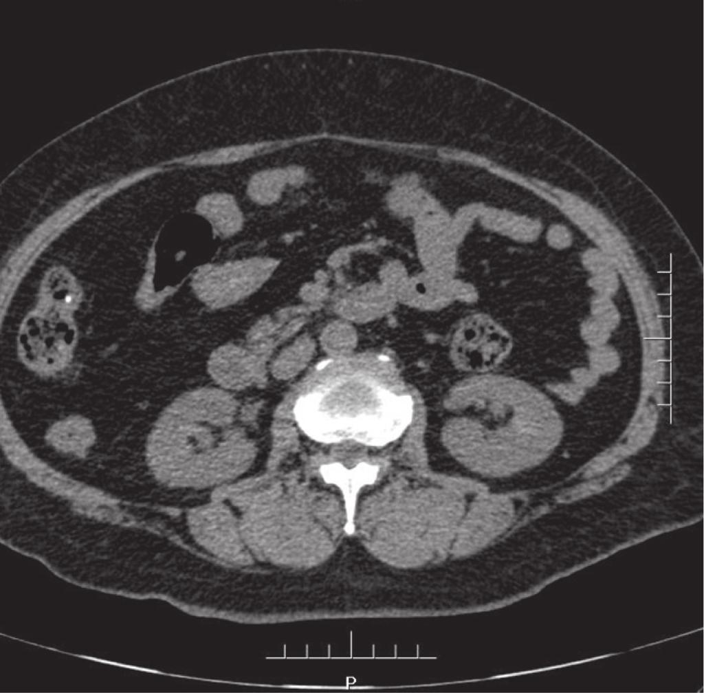 The renal function was normal, and patient had no pain. Figure 9. Postoperation Anterograde pyelography. (Fig.