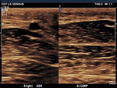 Great saphenous vein: SFJ, proximal thigh, mid thigh, distal thigh, proximal calf, mid calf Small saphenous vein: