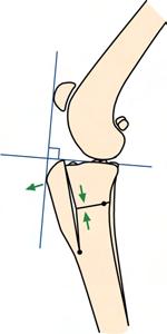 stifle was in a direction more parallel to the patellar ligament and reasoned that shear force on the CrCL can be eliminated by making the tibial plateau perpendicular to the patellar ligament.