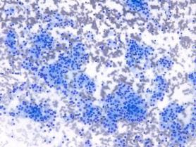 NIFTP (Non-invasive Follicular Thyroid Neoplasm with Papillary-like Nuclear Features) Endocrine Pathology Society working group in 2015 Cytopathologic diagnostic criteria for NIFTP?