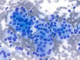 NONE NO NIFTP is a Histopathologic Diagnosis Educate your clinicians Good communication is needed Cyto-histo correlation could be crucial Cytopathology plays a screening role NIFTP Non-Invasive