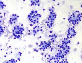 AUS/FLUS ROM 10-30% 2017 new subcategorization (descriptive) Cytologic atypia Architectural atypia Cytologic and architectural atypia Hurthle cell AUS/FLUS Atypia, NOS A single diagnosis carries a