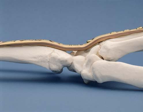 Indications Post-traumatic arthritis of the joints of the wrist Rheumatoid