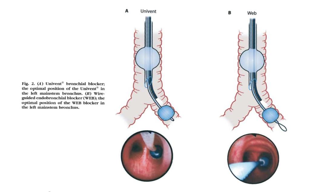 (A) Univent bronchial blocker; the optimal position of the Univent in the left mainstem bronchus.