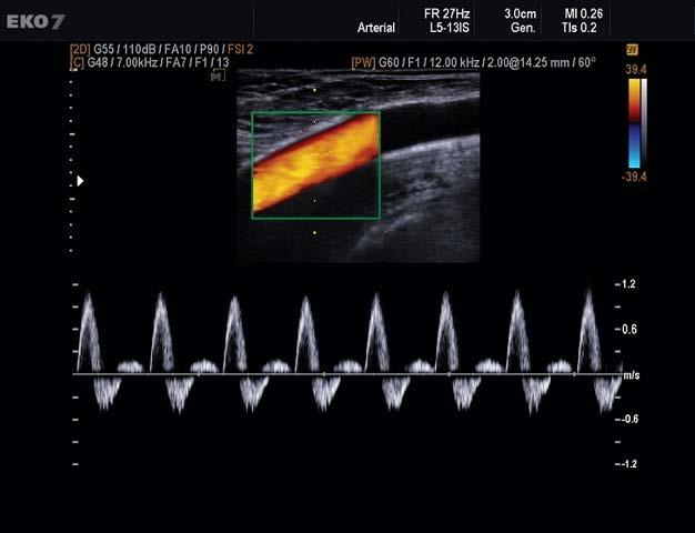 Doppler US Noninvasive Sonographer experience dependent Useful for diagnosing specific areas of significant stenosis