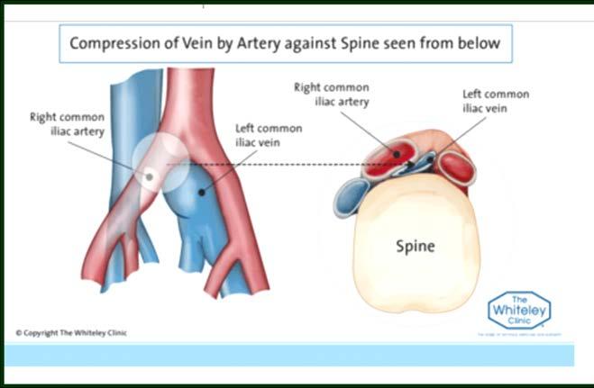 Iliac Vein Compression or May Thurner Anatomy