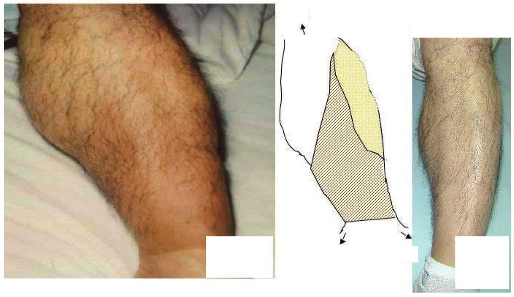Knee Pigmentation Pigmentation A. Left leg Heel Toe B. Schema for A C. Left leg Figure1. Pretibialmyxedema(Case1).A.Pretibialmyxedema()onadmision(0timein Fig.3).Thearrow indicatesthemarginof.b.schematicrepresentationfora.