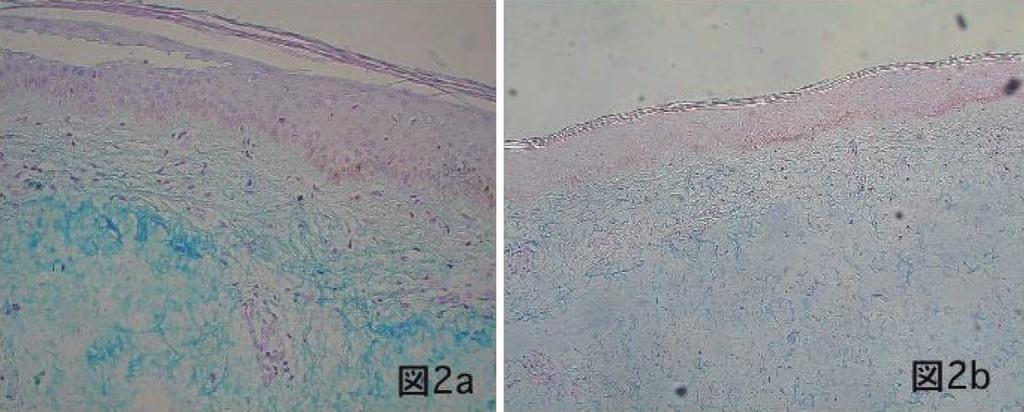 A B Figure2. Histologyofpretibialmyxedema()(Case1).