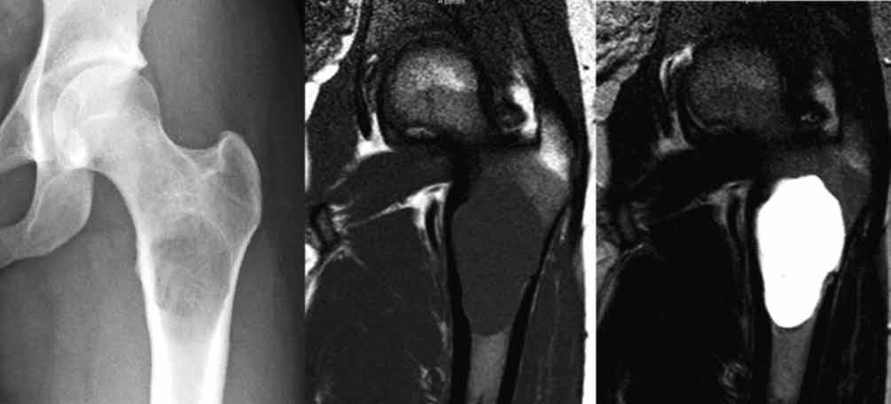 232 N. PiREAU, A. DE GHELDERE, L. MAiNARD-SiMARD, P. LASCOMBES, P.-L. DOCqUiER A B C Fig. 1. A. Standard anteroposterior radiography of a femoral SBC in a 21-year-old woman ; B.