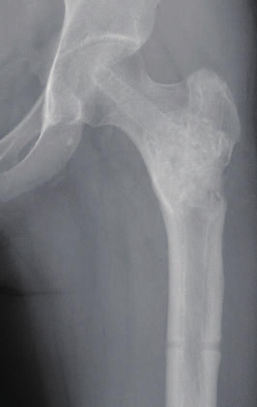 Hip Pelvis 28(3): 182-186, 2016 performed to prevent pathologic fracture (Fig. 3). Macroscopically, the pathologic specimen had abundant tan-brown soft tissue and multiple bone fragments.