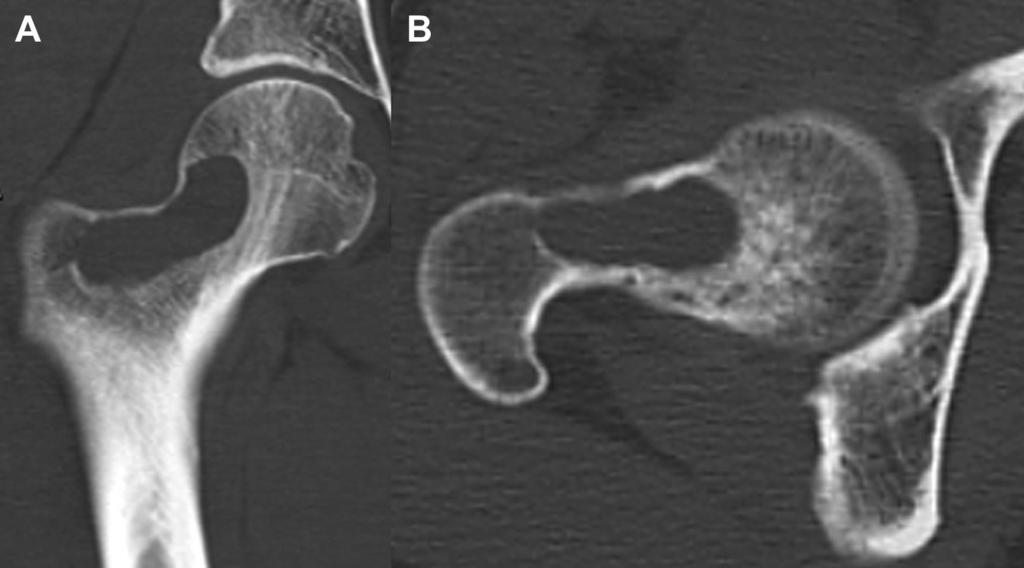 e468 W. MIYAMOTO ET AL. Fig 1. (A) Coronal and (B) axial views on preoperative computed tomography scans of the right proximal femur show a cystic lesion.