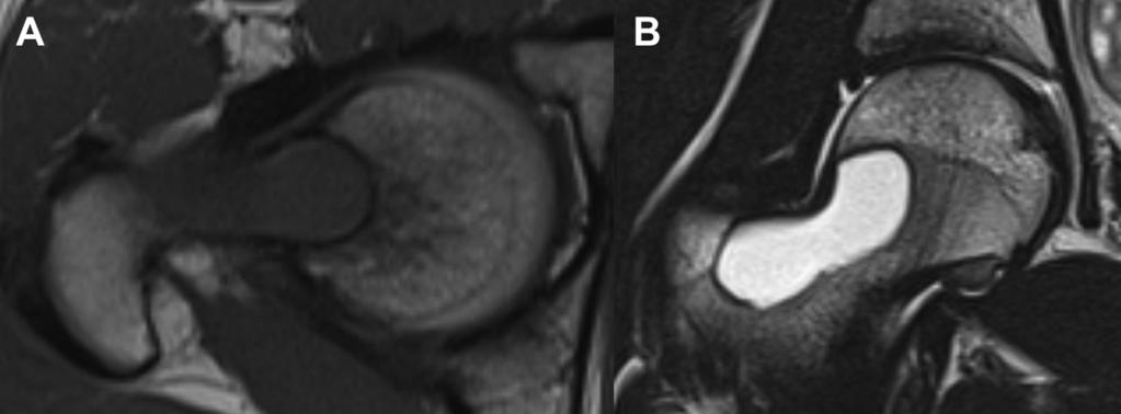 (B) A coronal T2-weighted image on the same part shows a hyperintense mass. These findings are evidence for the diagnosis of a unicameral bone cyst of the right proximal femur. is performed.