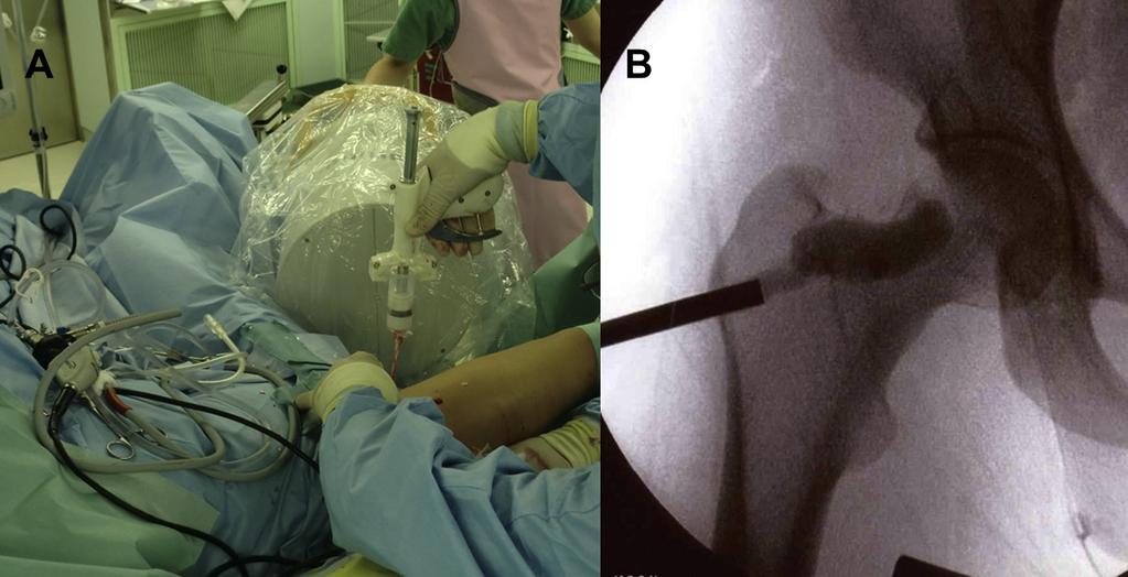 (B) Endoscopic imaging shows curettage of the fibrous inner surface by a forceps, which is inserted through the anterior portal under direct endoscopic visualization through the lateral portal.