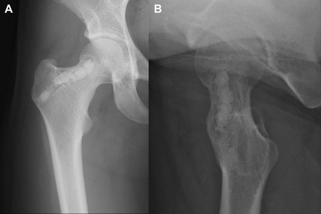 e470 W. MIYAMOTO ET AL. Fig 6. (A) Anteroposterior and (B) axial radiographs of right proximal femur 30 months after surgery, showing no signs of recurrence or pathologic fracture.