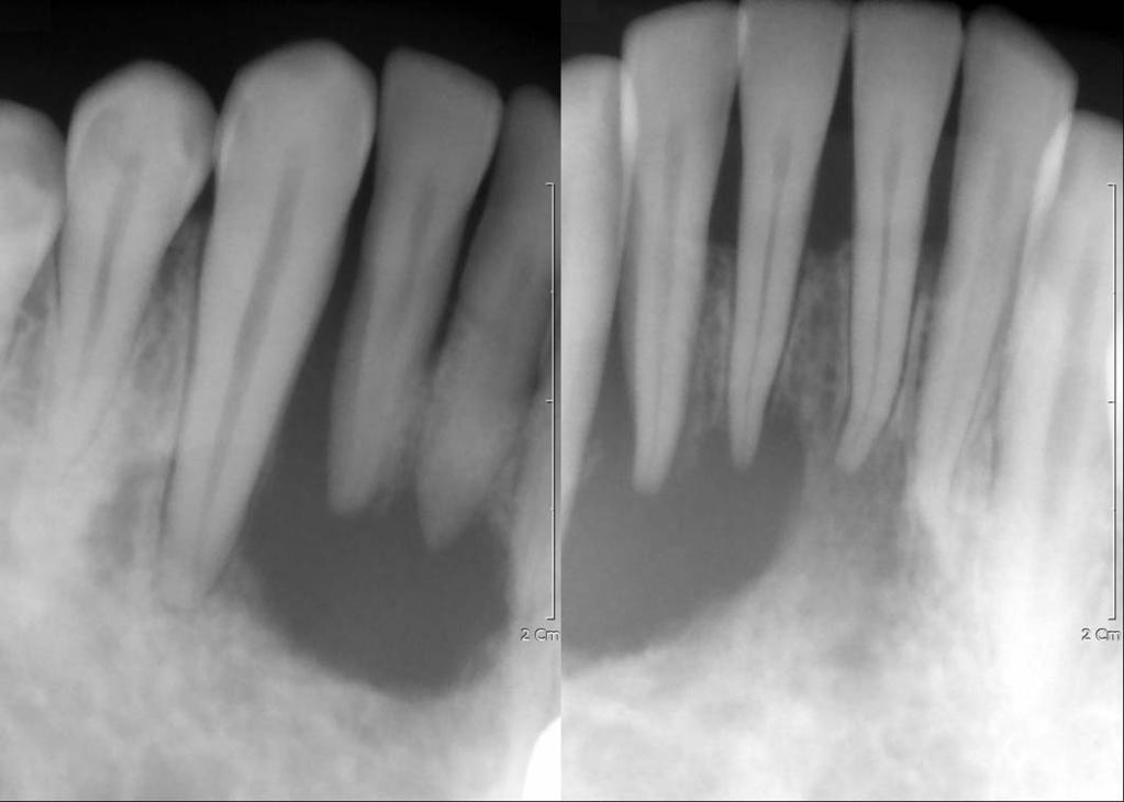 A periapical radiograph reveals a radiolucent lesion with a non-corticated border and beveled edges. The distal part of the right lower lateral incisor shows a floating tooth appearance.